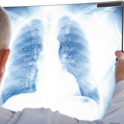 A doctor is holding up an X-ray of a patients lung, looking for signs of bronchitis.